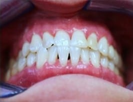 After Image: Zoom Teeth Whitening - front