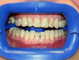 Before Image: Zoom Teeth Whitening - front